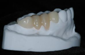 Snaprothese auf dem Modell